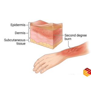 سوختگی درجه 2